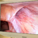 Operace kýly - 4_Tselnklavzobrazen4Kpilaparoskopickoperaci_fotoKlinikaGHCPraha_reprozdarma