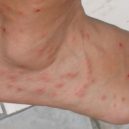 Ořechy proti štěnicícm - bed bug bites
