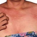 Zákeřný nepřítel – alergie na sluneční záření - Zákeřný nepřítel – alergie na sluneční záření 5
