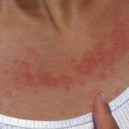 Zákeřný nepřítel – alergie na sluneční záření - Zákeřný nepřítel – alergie na sluneční záření 6