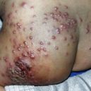 herpes - herpes