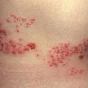 herpes - herpes_1