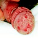 herpes - opar_1