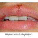 herpes - opar_2