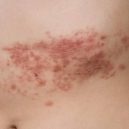 herpes - opar_3