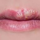 herpes - opar_4