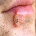 herpes - opar_5