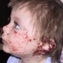 herpes - opar_6