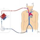 ECMO ve VFN - VV-ECMO-Fem-Jug1
