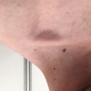 Stan proti melanomu 2019 - Pendlující fibrom je nezhoubný vazivový výrůstek a má ho na kůži řada z nás.