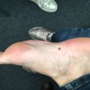 Stan proti melanomu 2019 - Počítač zanalyzoval, že znaménko na chodidle může být rizikové. Lékařka doporučuje kontrolu jednou ročně na kožním.