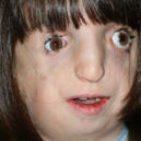 Když se narodila, lékaři jí předpovídali dva roky života. Pacientka Eva trpí vzácným syndromem - Treacher_Collins_syndrome_(MedMedicine)