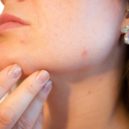 Akné (Acne vulgaris) - akne plet