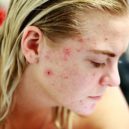 Akné (Acne vulgaris) - akne plet