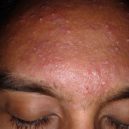 Akné (Acne vulgaris) - akne plet