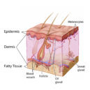 Akné (Acne vulgaris) - kuze plet