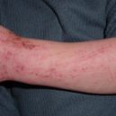 Alergie - Atopická dermatitida